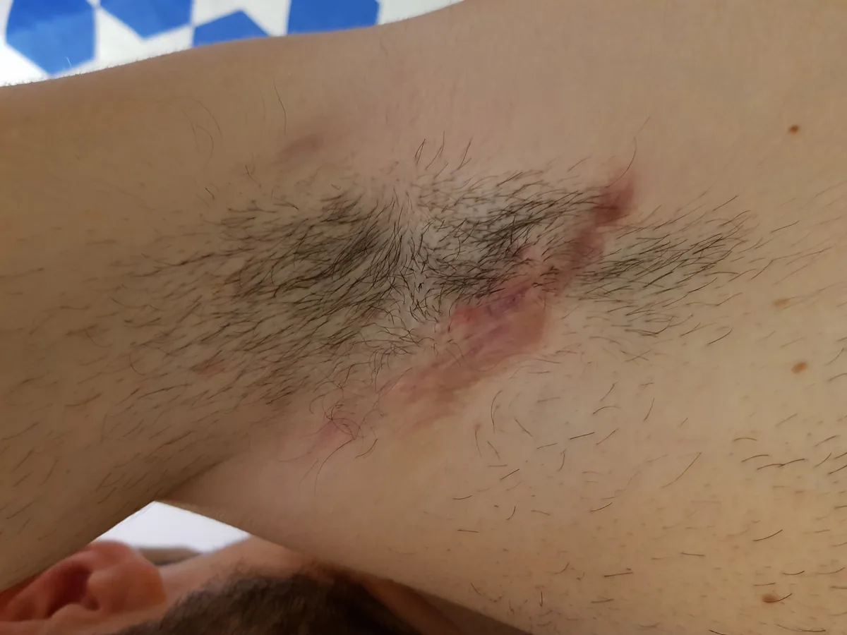 The same armpit years later: visible scars, no active lesions