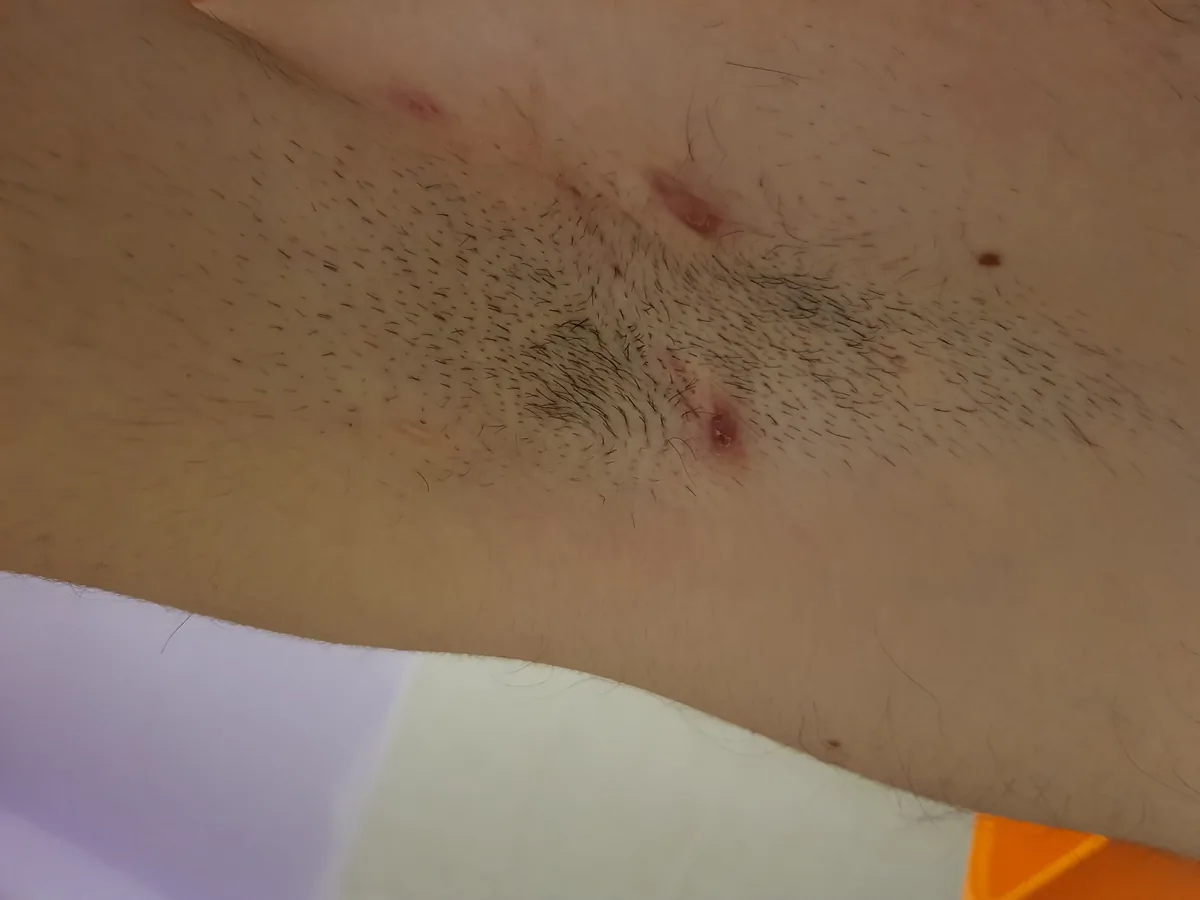 The same armpit six months later: visibly calmer skin