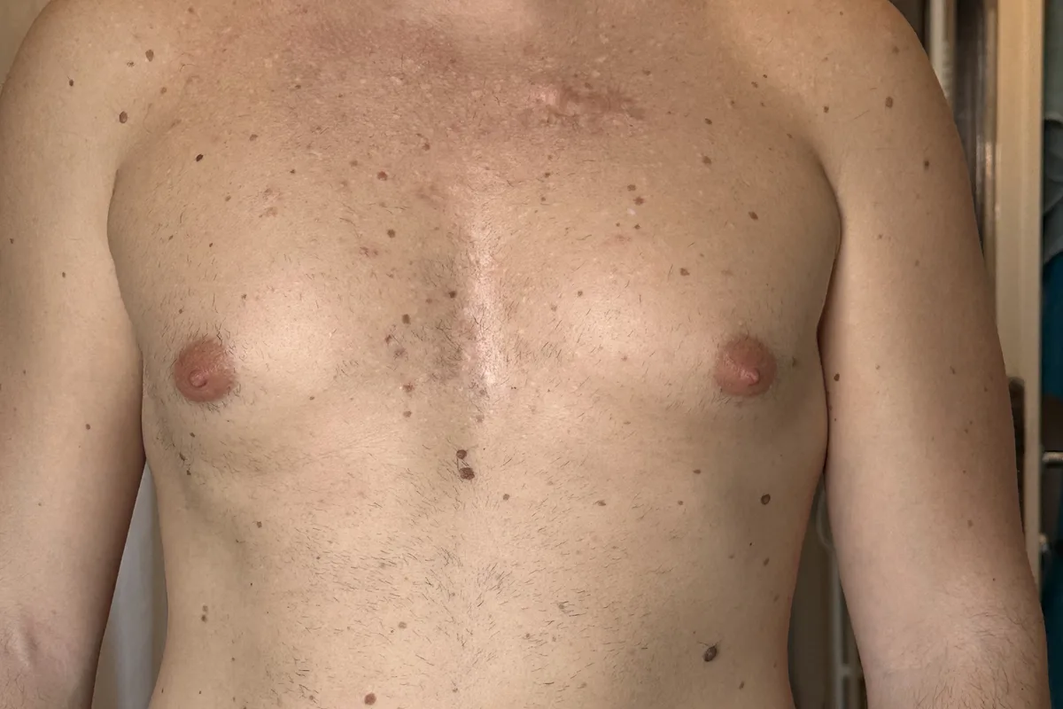 The same chest seven years later: stable skin with residual scars
