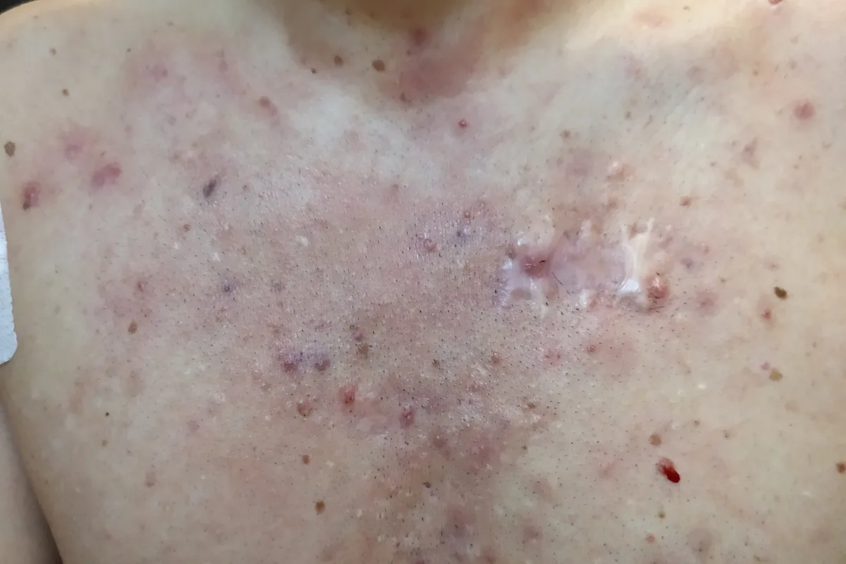 Chest with active lesions and scars from Hidradenitis Suppurativa